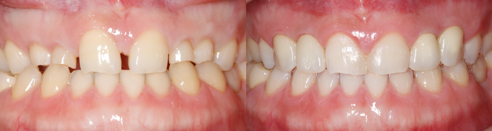 발치 후 즉시 임플란트 과정